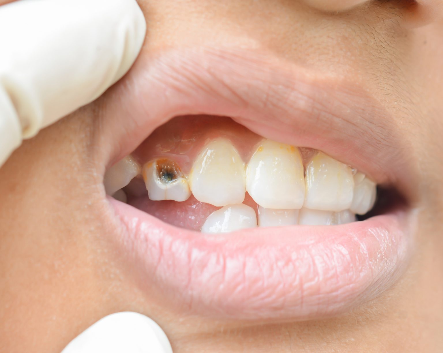 Foto De Dente Estragado LIBRAIN
