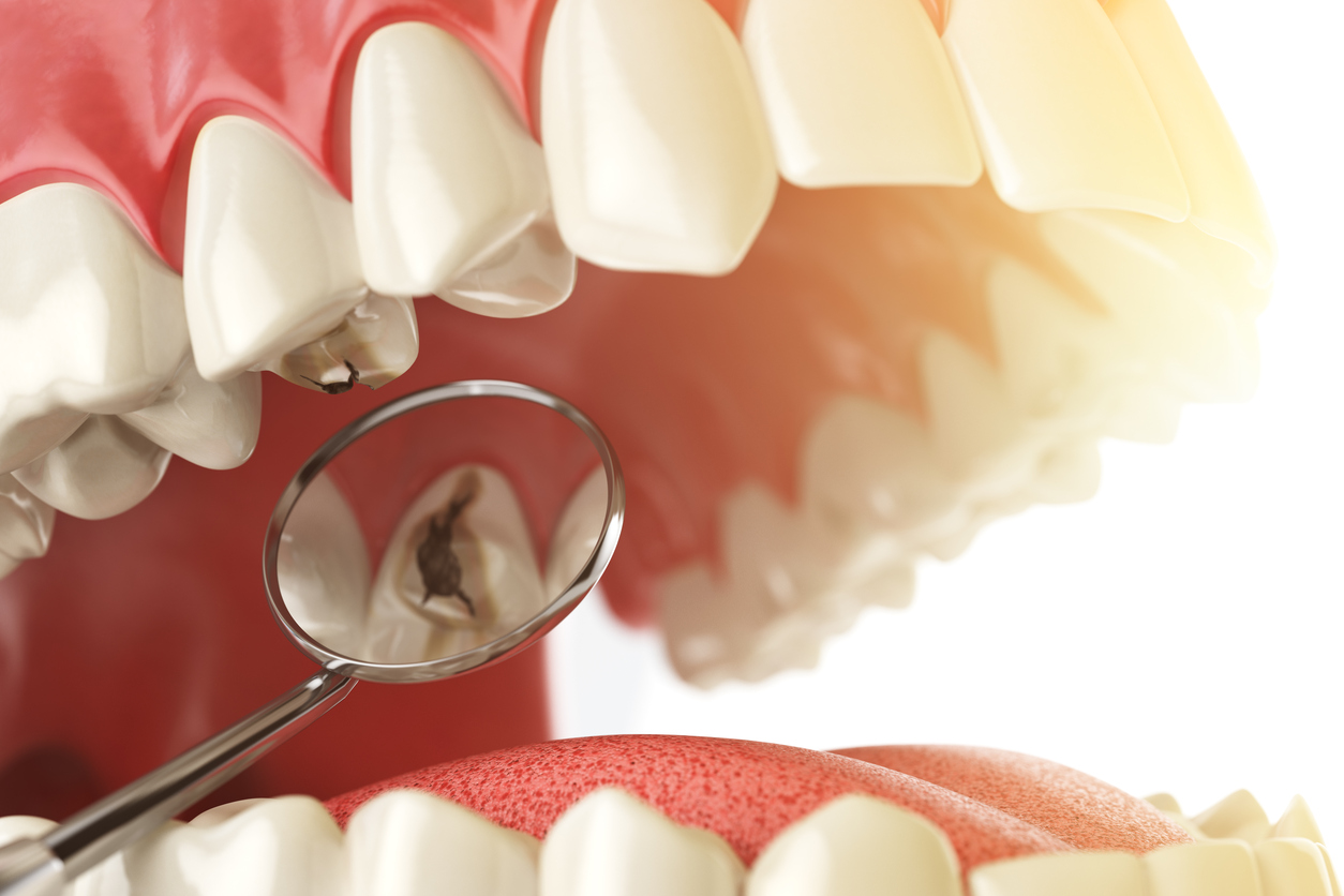 Tips To Clean Dentures And How To Avoid Bacteria Buildup