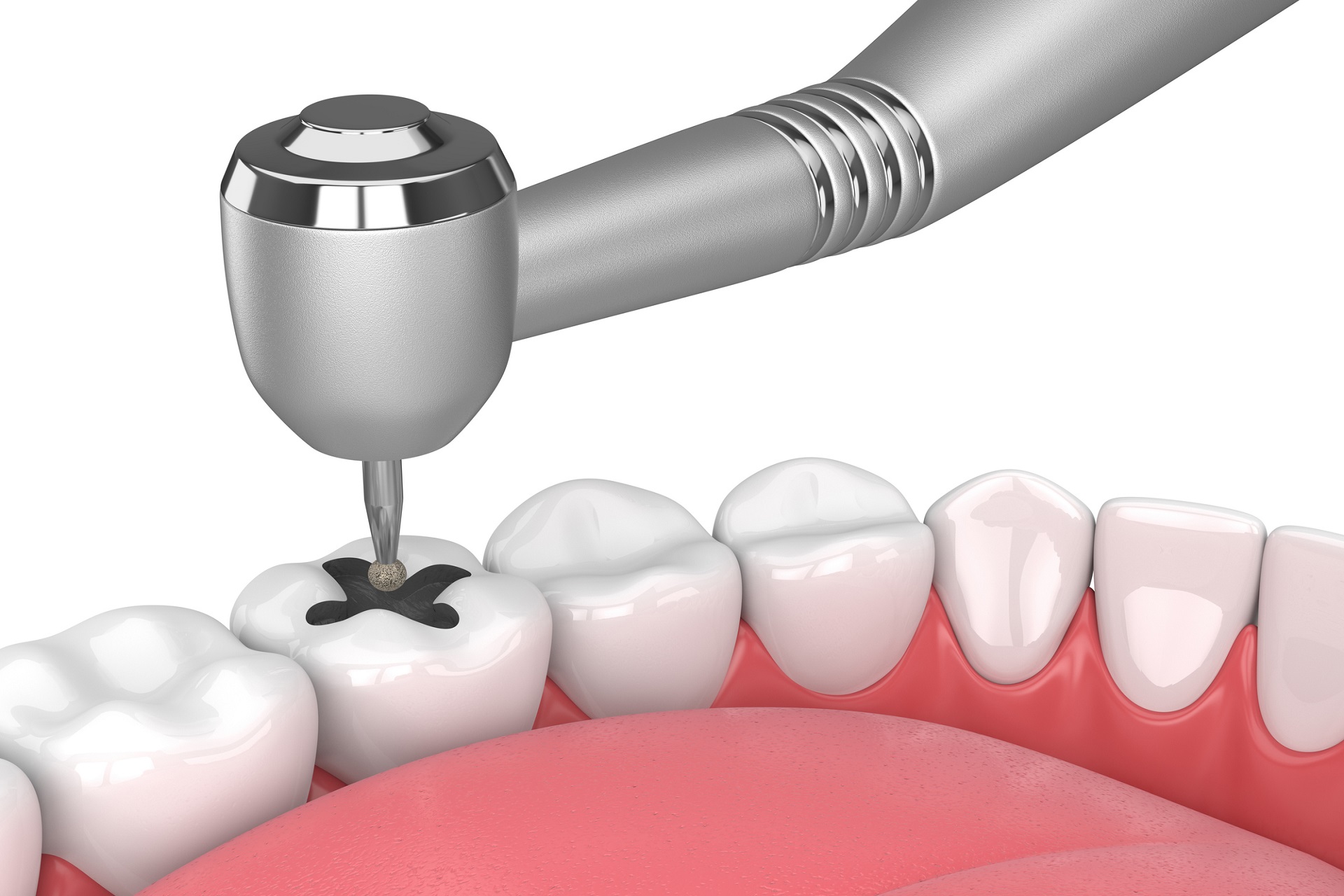 Know About the Amalgam Fillings and Safety Measures Blog