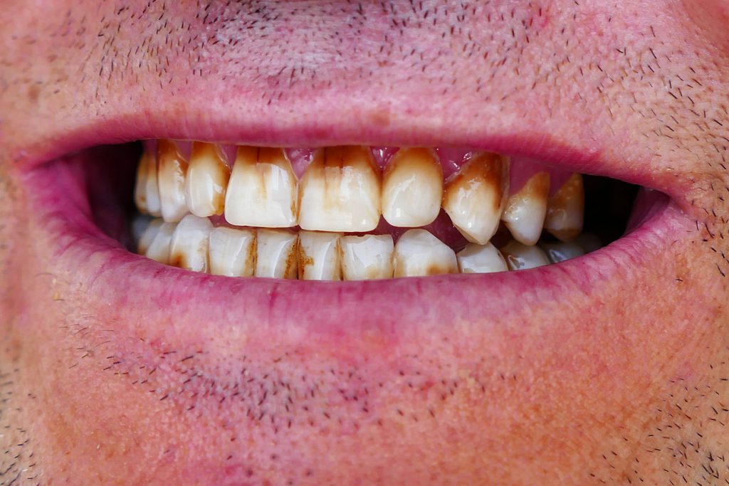 Teeth Staining Frequently Asked Questions Tooth Discoloration