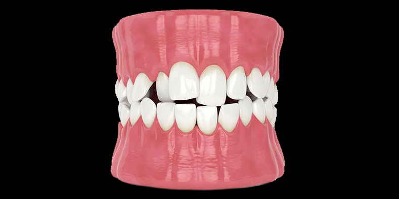 Image showing crooked teeth