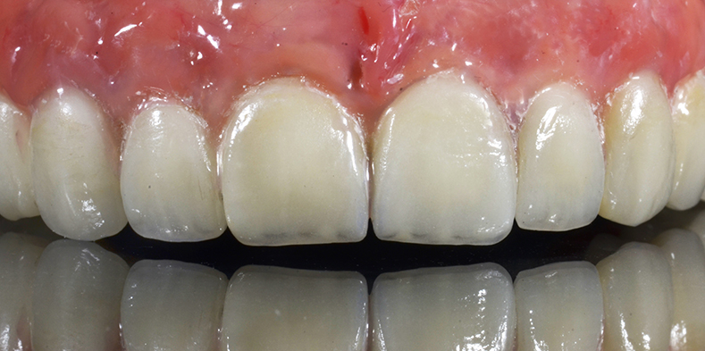 Discoloured teeth due to staining