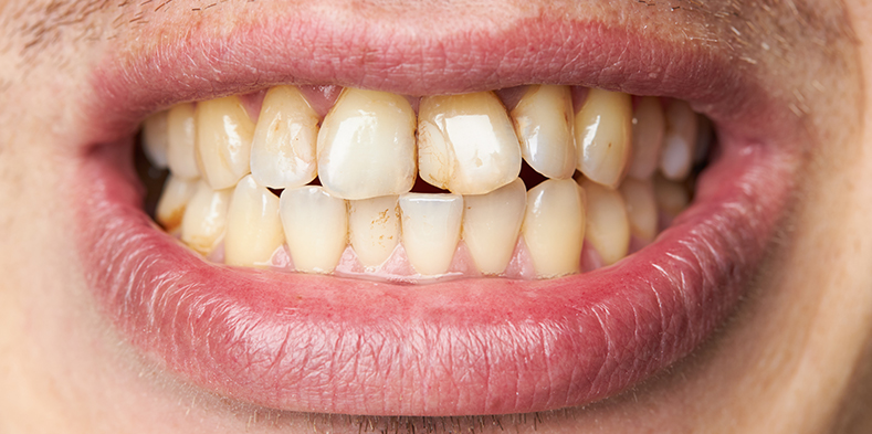 Image of crowded teeth