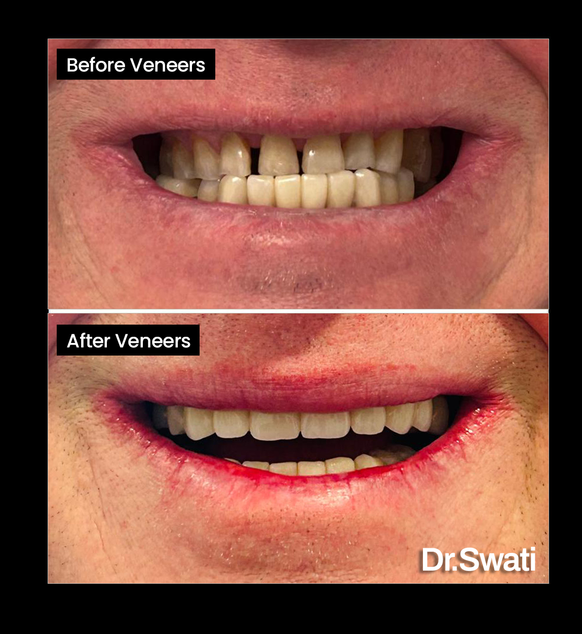 Before and after image of gappy teeth