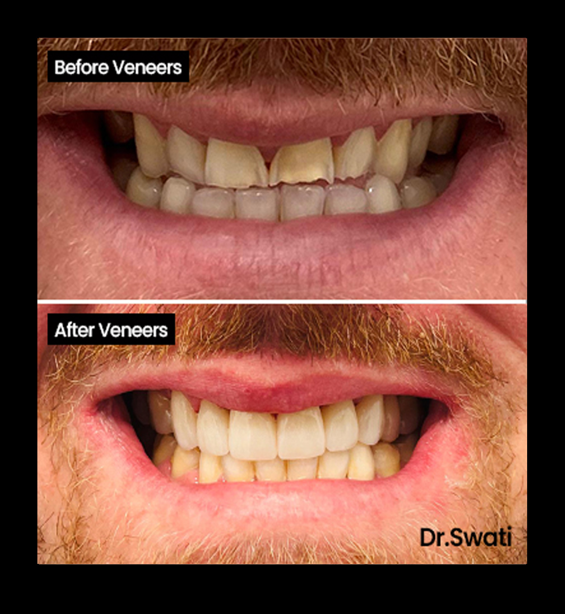 Before and after image of Crooked teeth