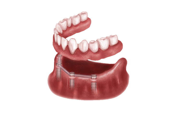 Digital denture