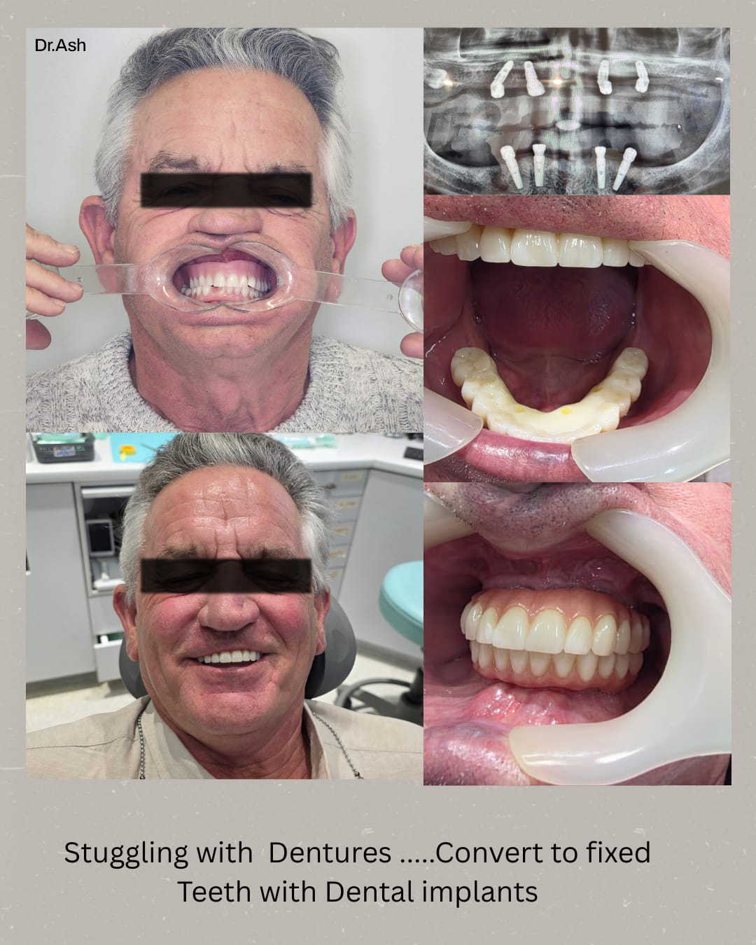implant supported dentures