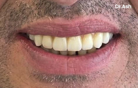 After image