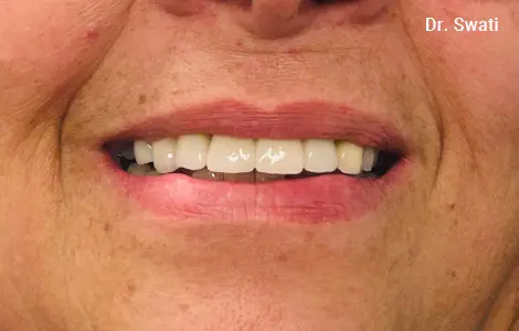 After image