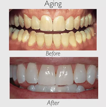 Pola Teeth Whitening | Springvale Dental Clinic