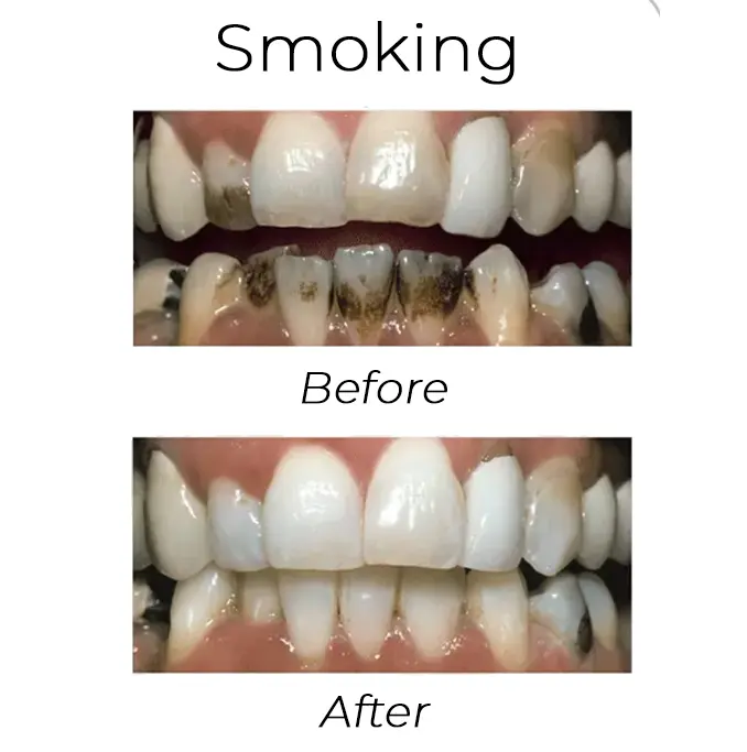 Smoking before and after
