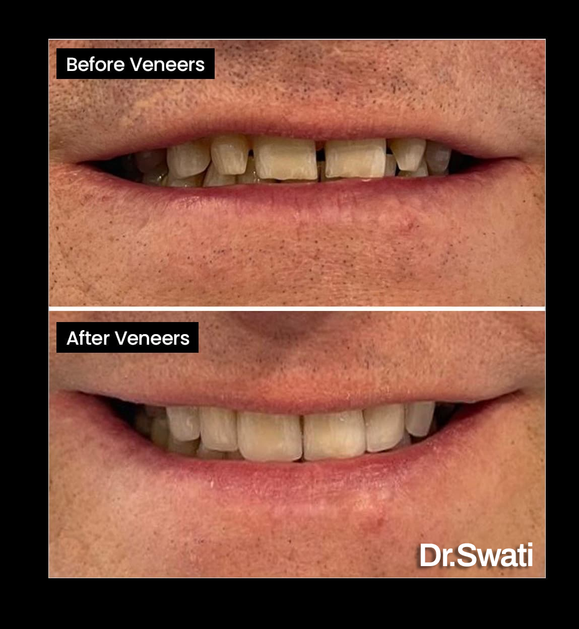 Before and after image of Discoloured teeth