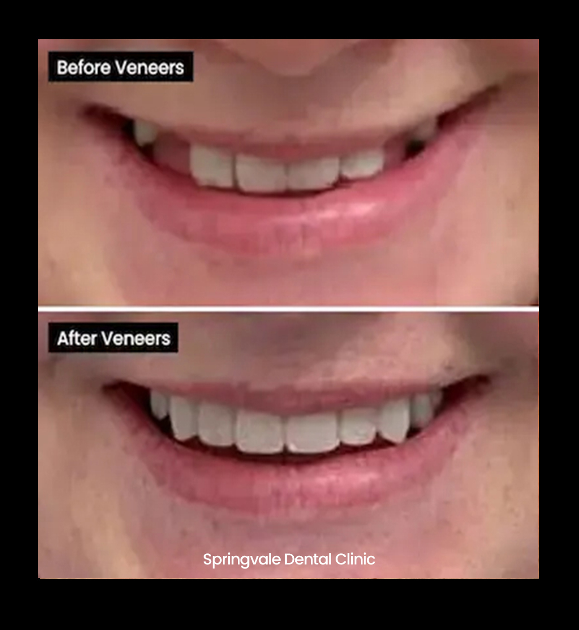 Before and after image of gappy teeth