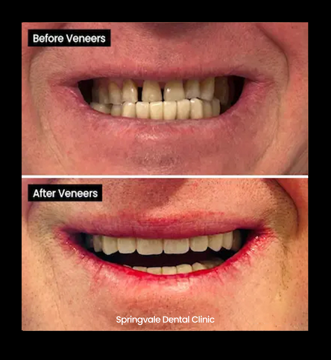 Before and after image of gappy teeth