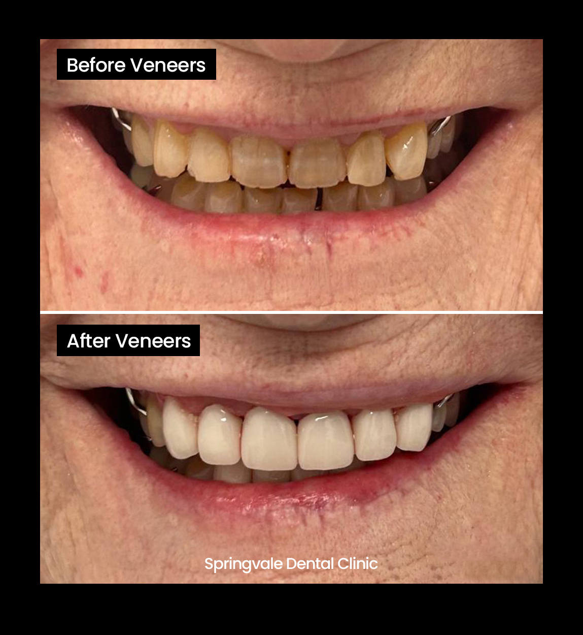 Before and after image of Crooked teeth
