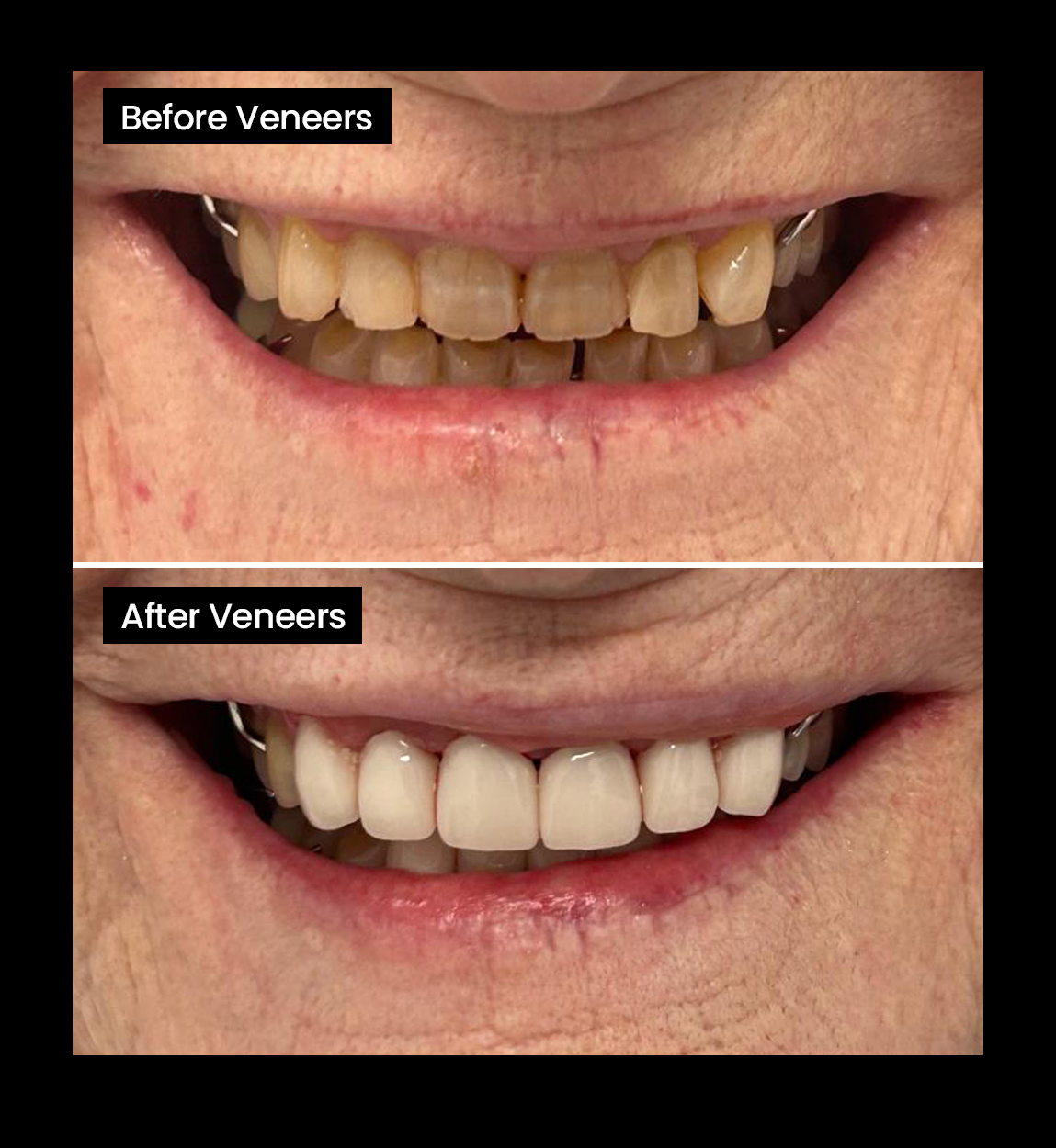 Before and after image of Crooked teeth