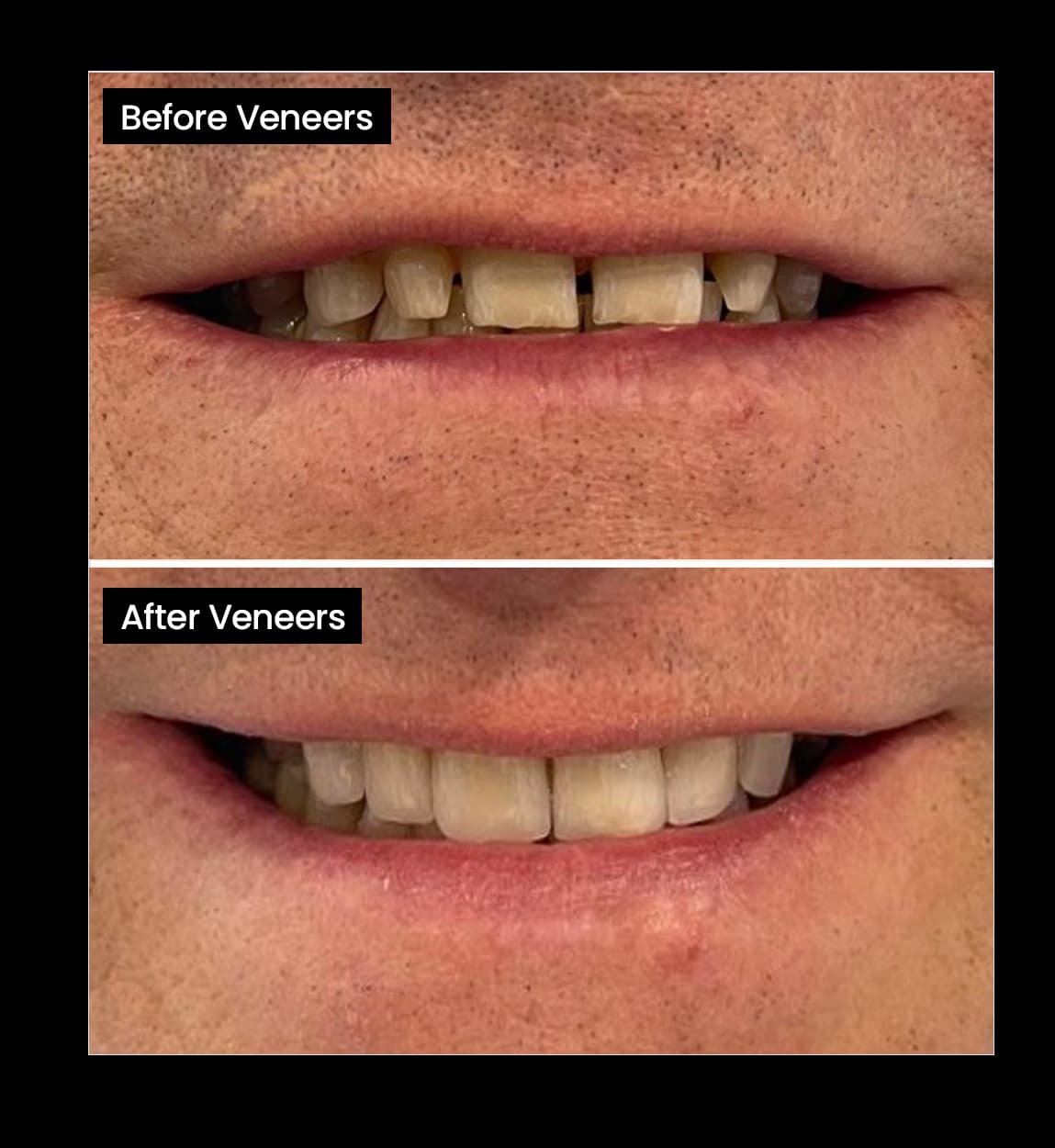 Before and after image of Discoloured teeth