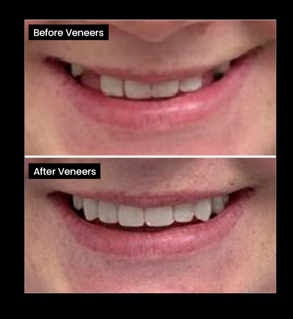 Before and after image of gappy teeth