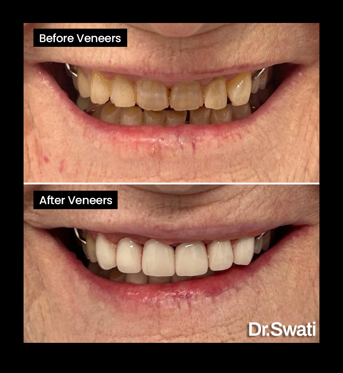 Before and after image of Crooked teeth